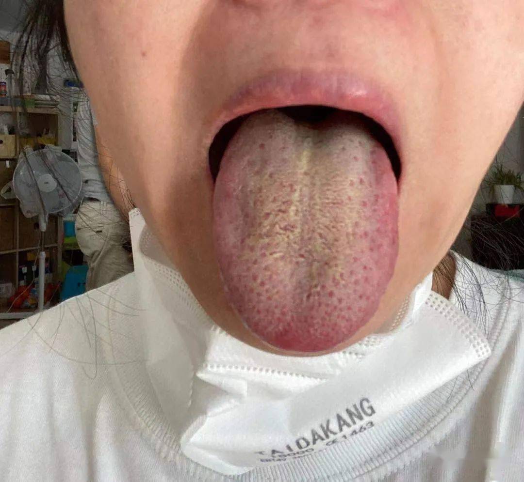 下面是患者8月1日的舌苔照片,非常厚腻,照片明显说明了"新冠肺炎"的