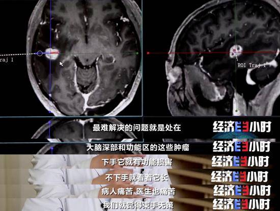 技术|重大利好！不开颅治疗脑肿瘤，费用预计为国外的5%！
