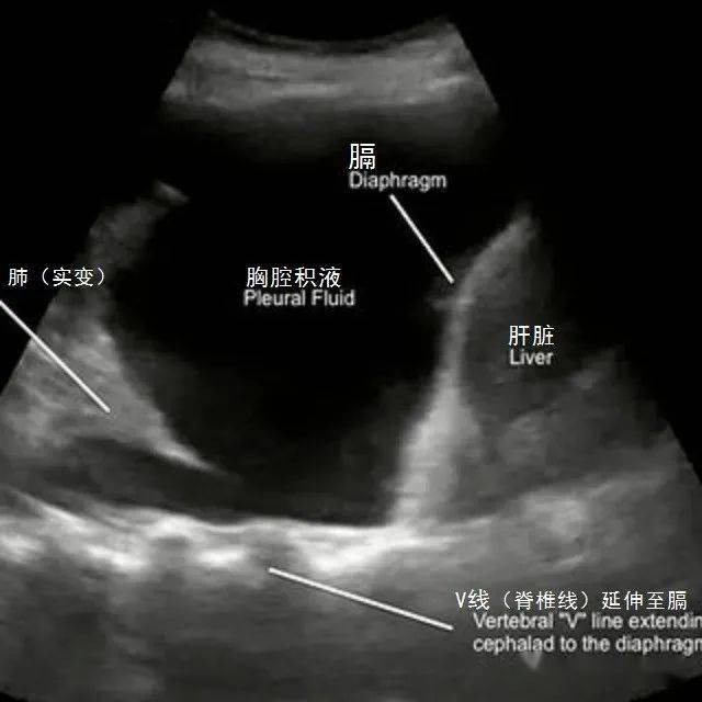大龄游离胸腔积液作为声窗能够直接显示深方的椎体强回声,称为v线.