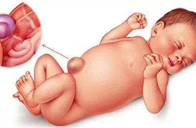 新生儿肚脐4个异常要注意这篇宝宝脐部护理攻略送给宝妈