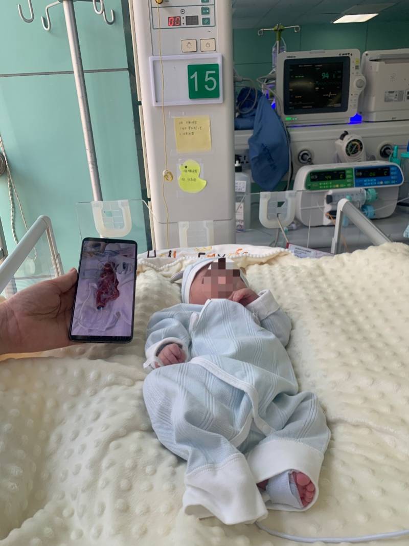 全国罕见22周胎龄不到1斤的超早产儿健康出院