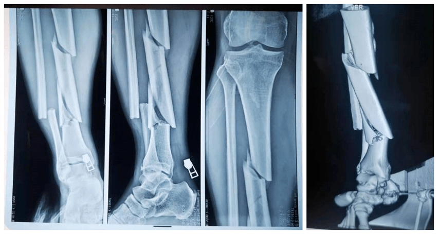 理塘县医院创伤骨折手术进入微创时代