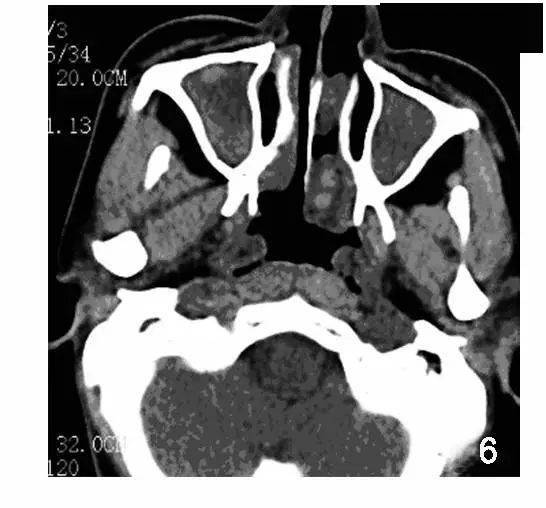 支气管|中年女性不明原因咳嗽40年，听诊居然没有心跳？！