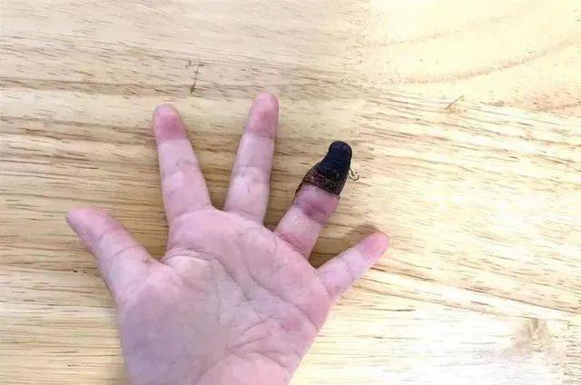 一个月前,欢欢独自在家玩时,不小心弄伤了左手的无名指,家人带欢欢