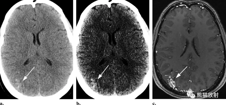 (a)ct平掃顯示右頂葉(箭)皮層及皮層下可見簇狀略高密度.