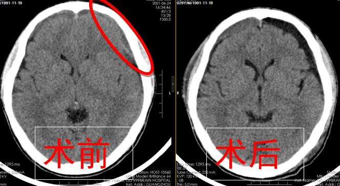 神經外二科團隊為患兒實施