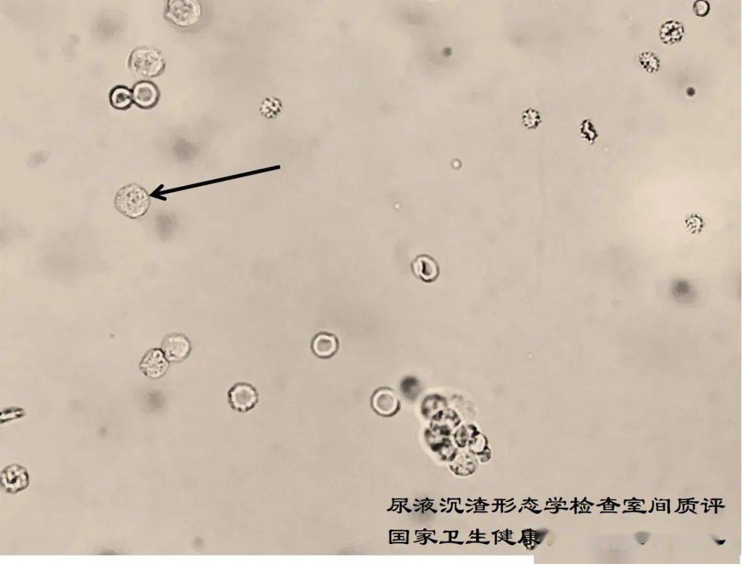 2021年尿液沉渣形态学检查室间质量评价