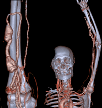 静脉|肾内科完成首例DSA下中心静脉狭窄球囊扩张术