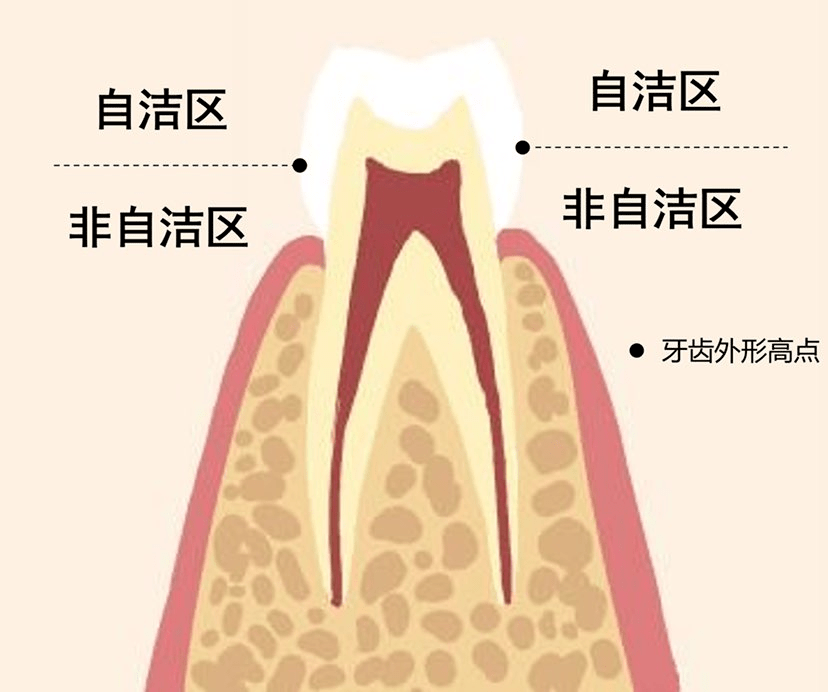 而牙齒上靠近牙根的,腰部以下部分,屬於 「非自潔區」,這個區域最