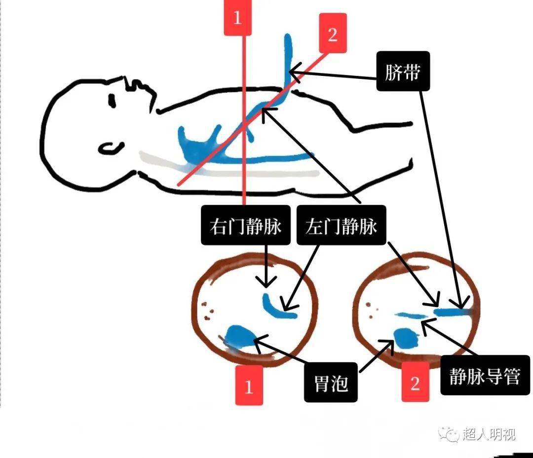 脐静脉注射方法图片