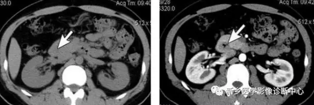 弹簧|图解21种腹部疼痛原因