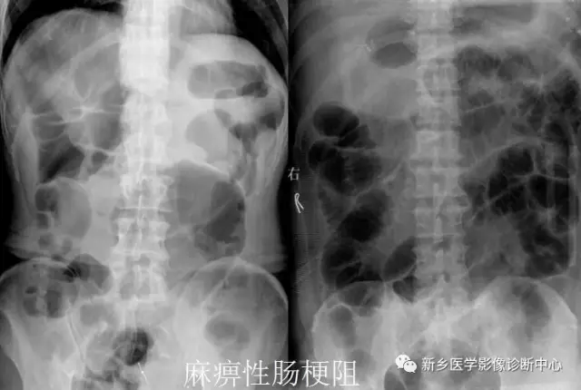 弹簧|图解21种腹部疼痛原因