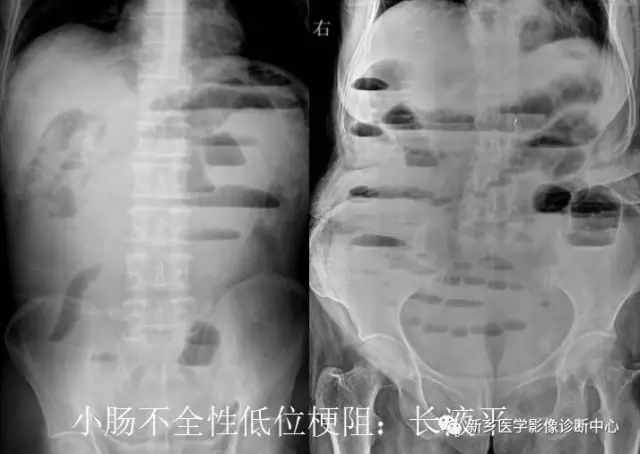 弹簧|图解21种腹部疼痛原因