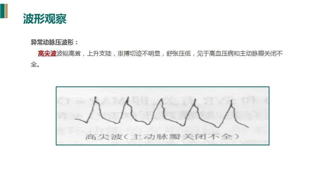 【ppt】有创动脉血压监测的护理(附具体操作精彩视频)