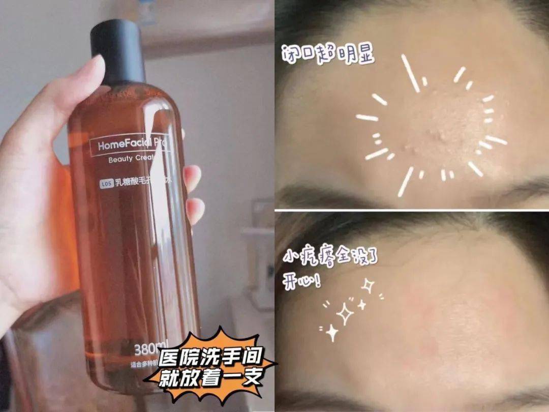 黑头|阿娇没骗我！2块钱敷一次酸，脸上“小疙瘩”竟被吞了！