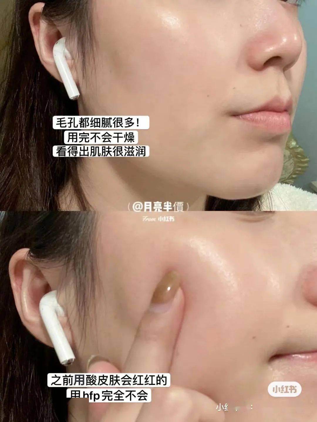 黑头|阿娇没骗我！2块钱敷一次酸，脸上“小疙瘩”竟被吞了！