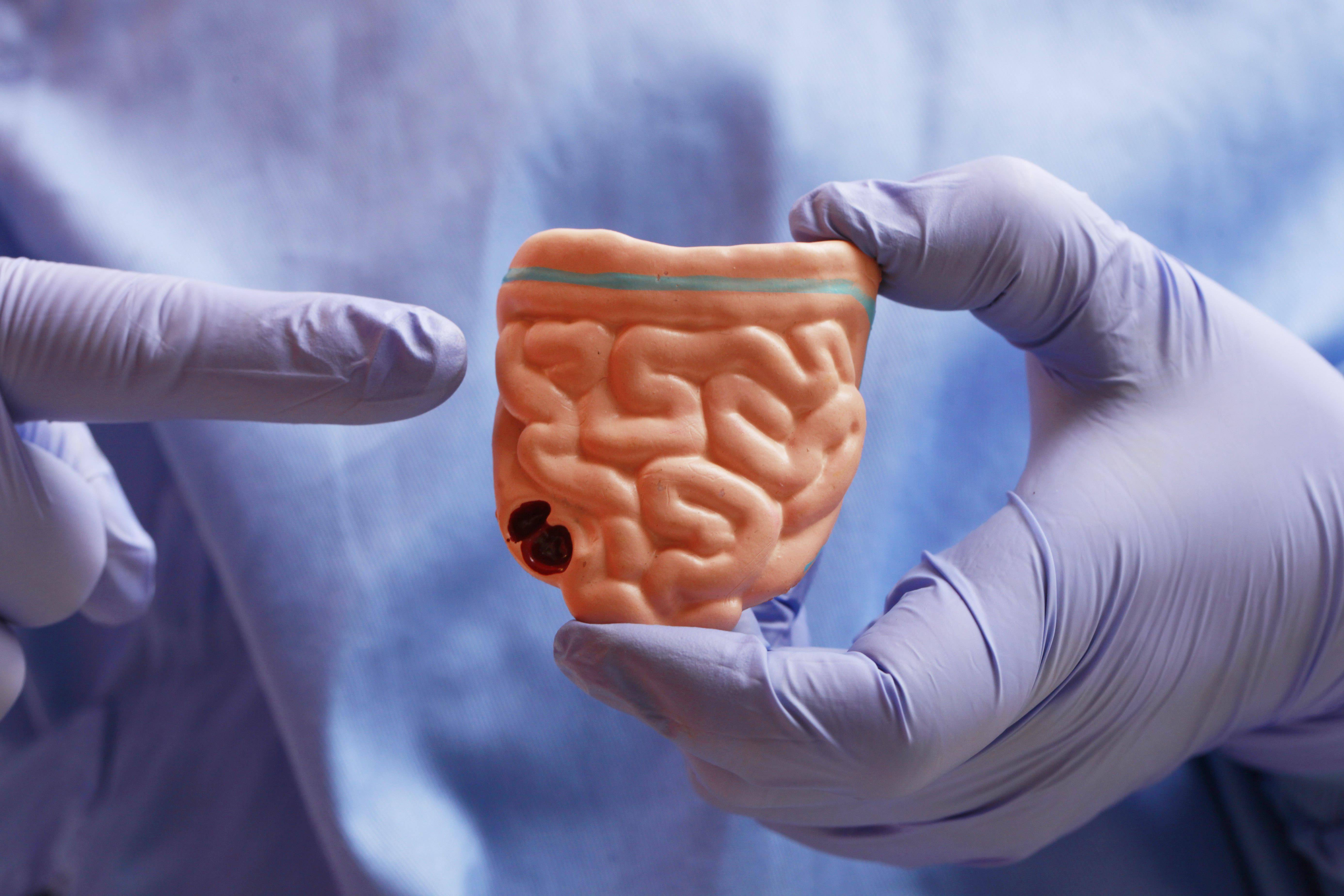 大便|情绪紧张总想跑厕所 也许是肠易激综合征找上门