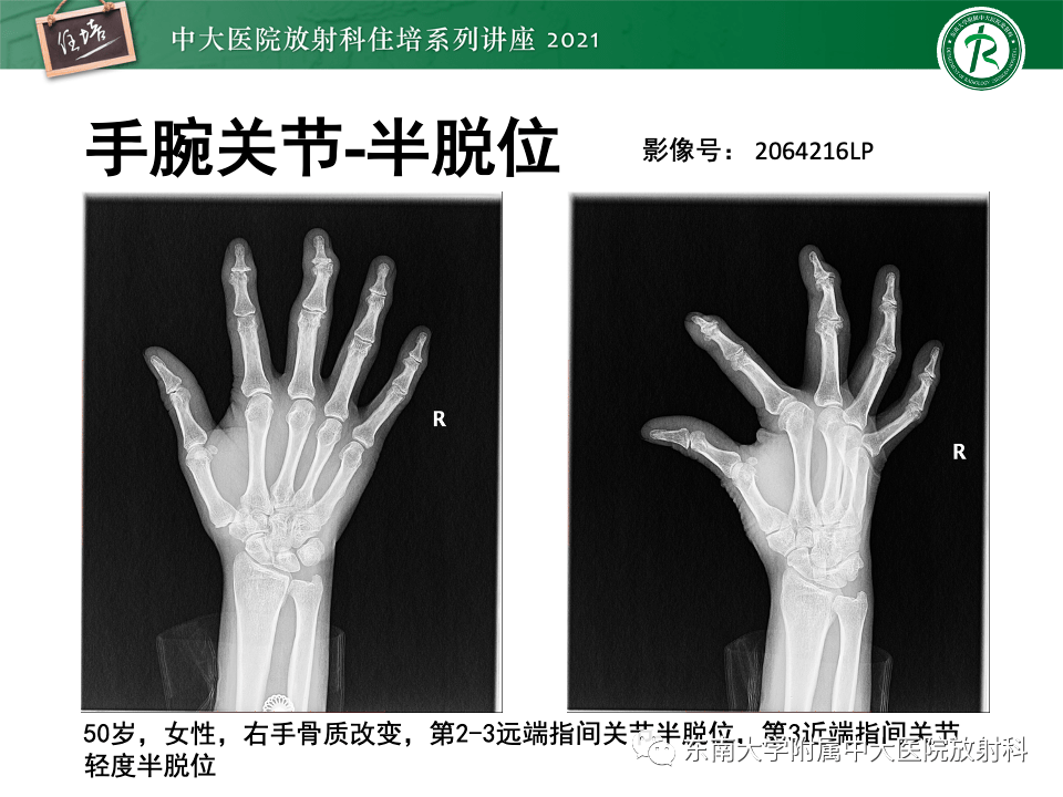 類風溼關節炎的影像學診斷