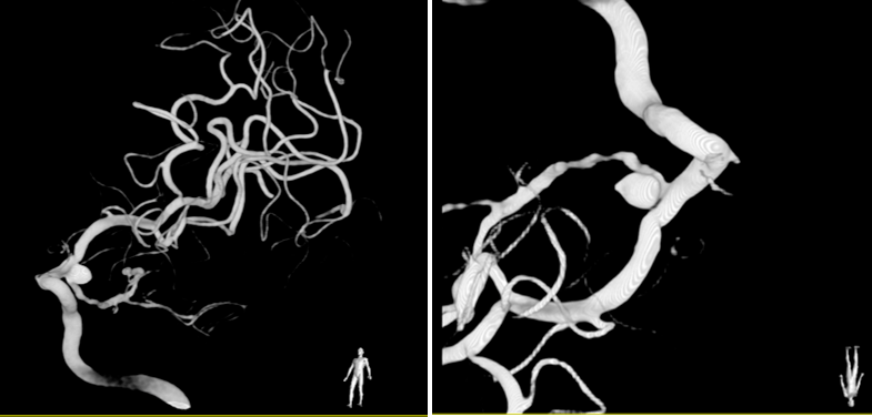 病例分享一例重症蛛网膜下腔出血患者容量管理之思考神经急重症系列三