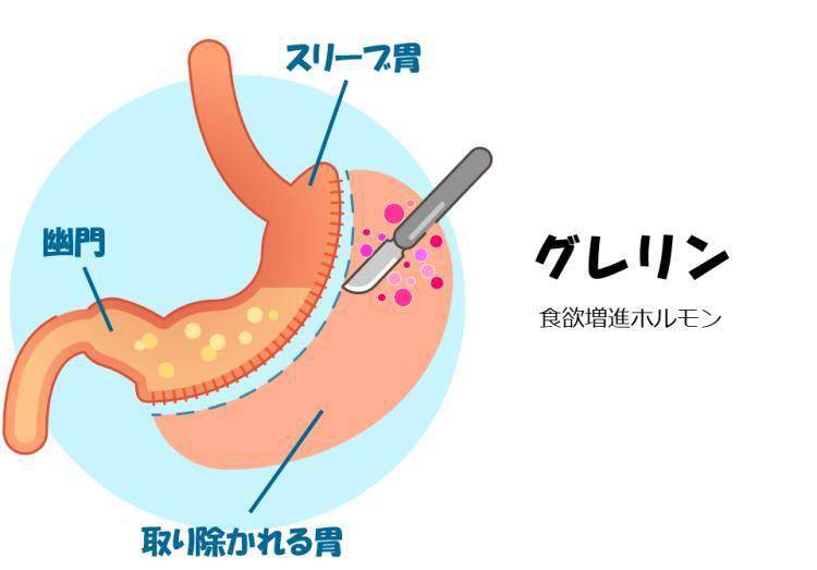袖状胃切除手术,俗称"缩胃",又叫做腹腔镜胃袖状切除术,原理是利用