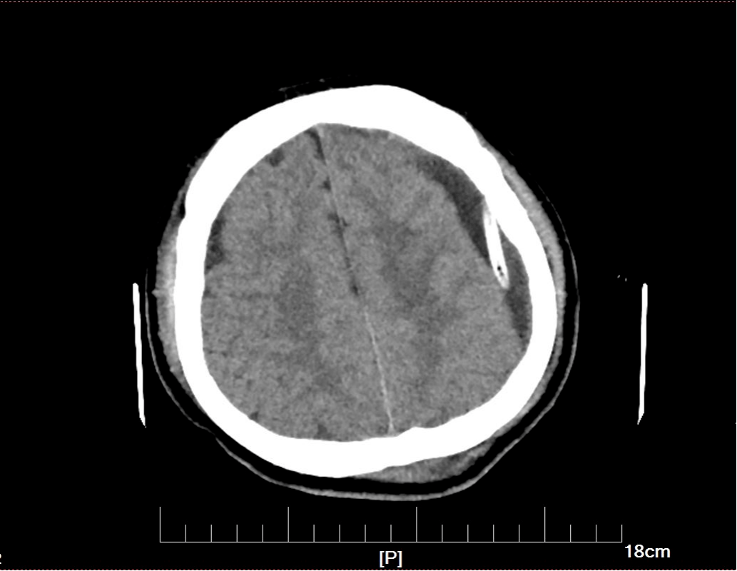 科室见面会天坛医院刘伟明吴量慢性硬膜下血肿的穷尽引流法及中药治疗