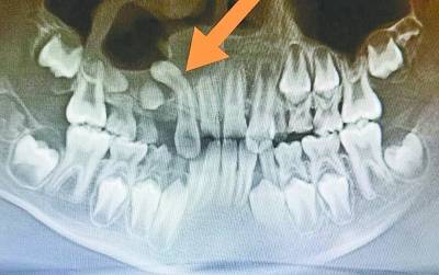 反转|“调皮”多生牙“翻着跟头”长出来