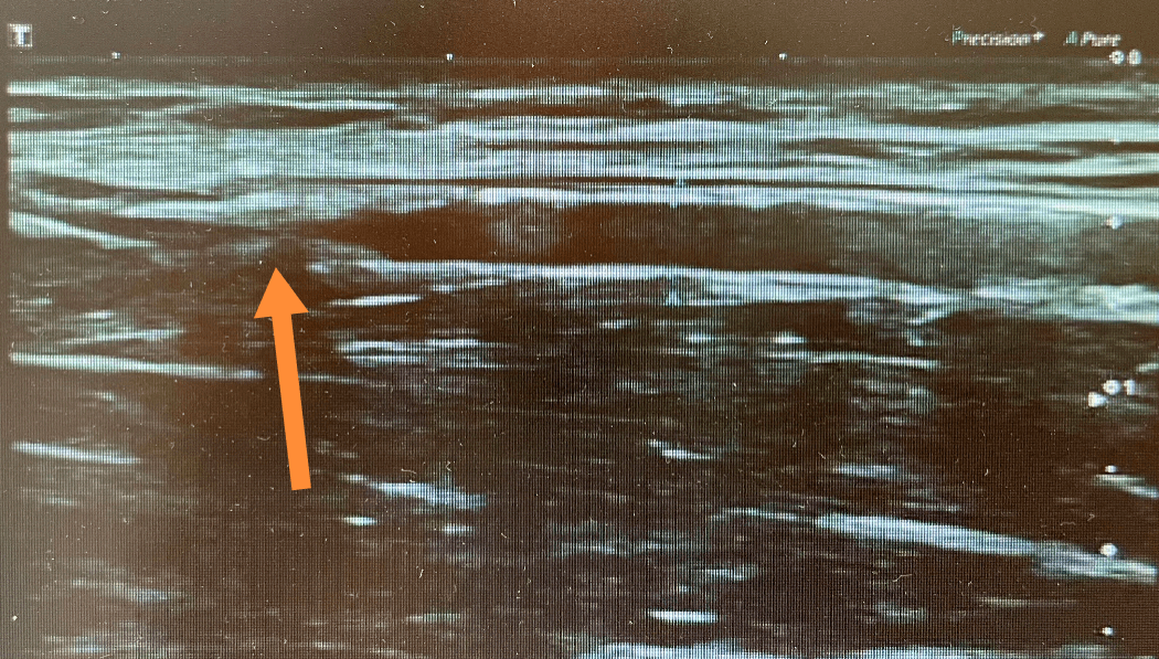 进行|【医患一家】精益求精,迎难而上,肾内科为血液透析患者重建“生命线”