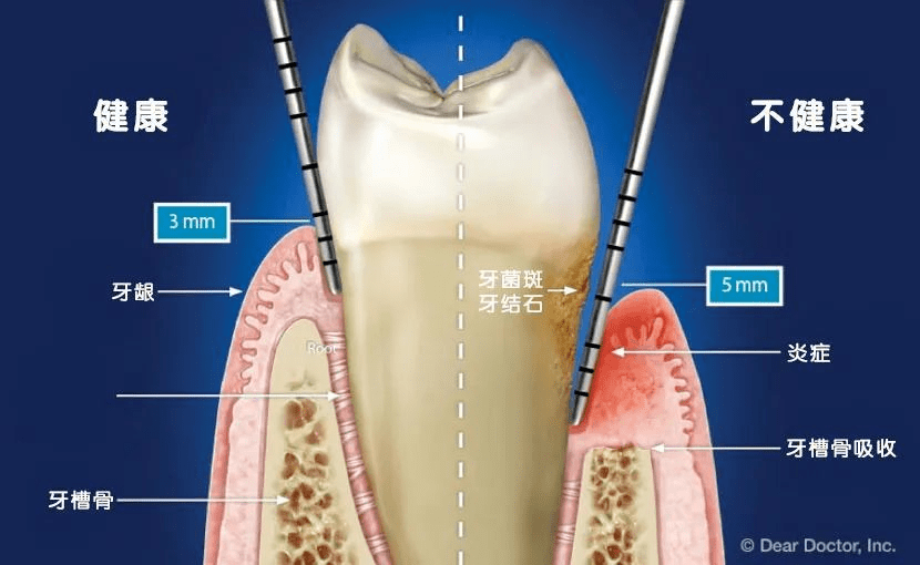 因为洗牙就是用超声洁治器去除牙龈边缘及龈沟里那些牙结石和牙菌斑