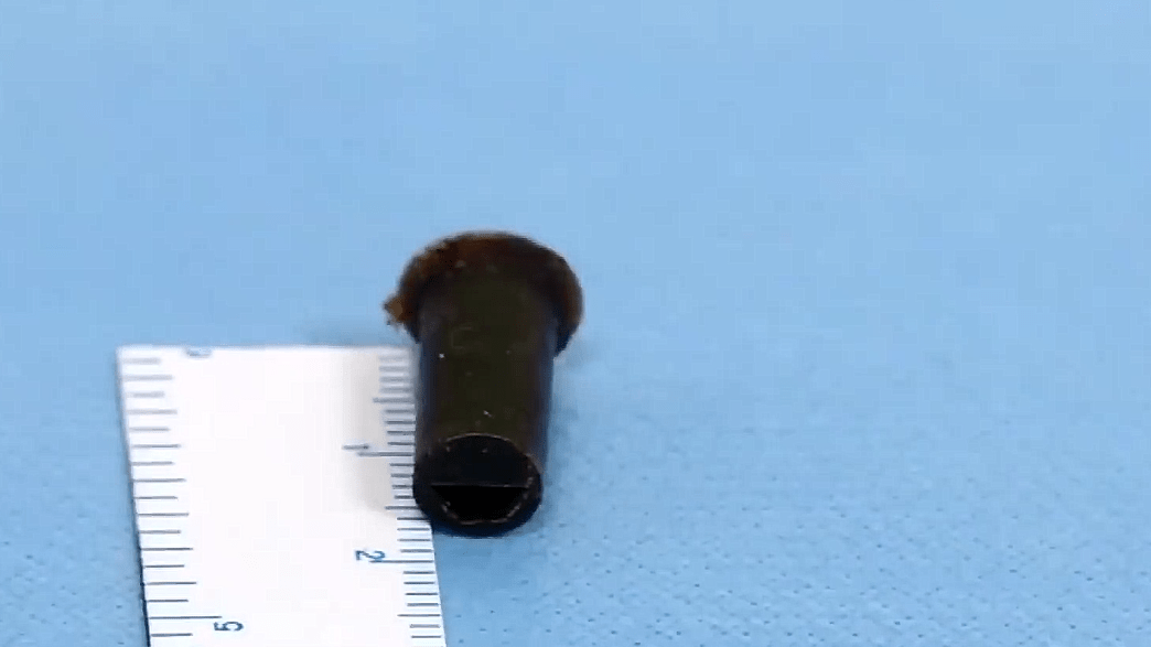 发声|冲上热搜！男子6岁吞哨子怕被骂瞒了20年，多年来反复肺炎?