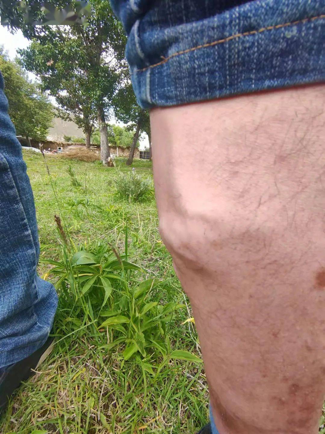 第三天反馈:静脉结团处大的包块明显小了很多,仅有轻微的突起.