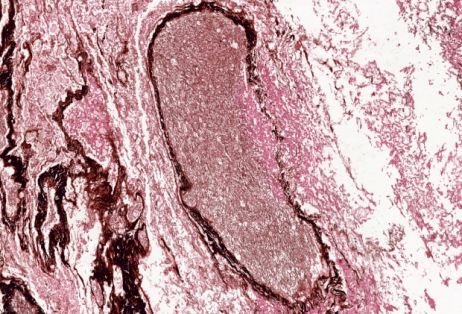 灌注|全身+局部 介入+灌注，清华长庚呼吸科治愈顽疾“肺毛霉菌病”