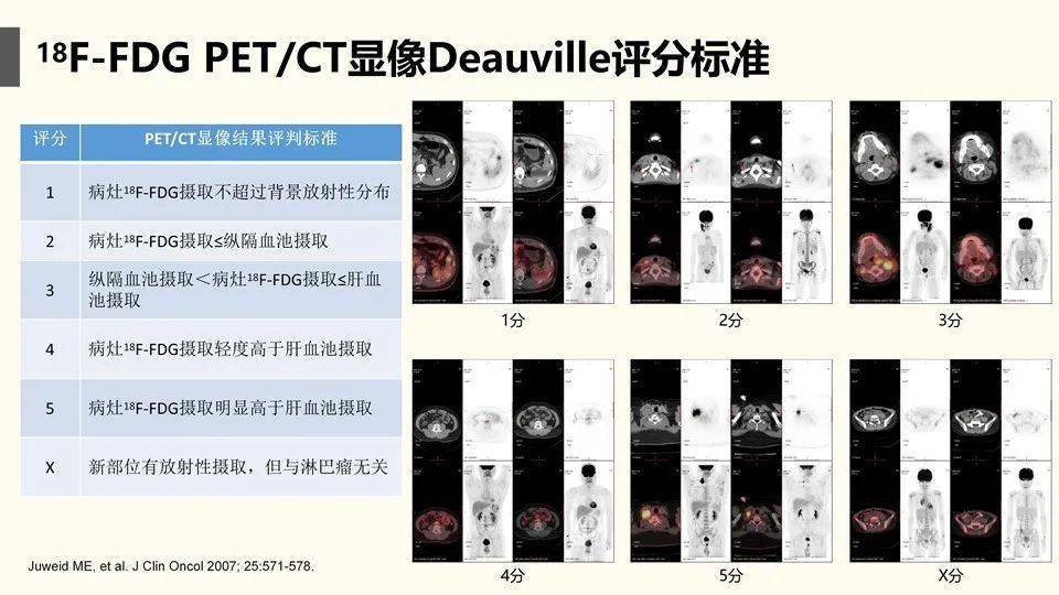 讲座第93期雷霄教授petct在儿童淋巴瘤中的应用