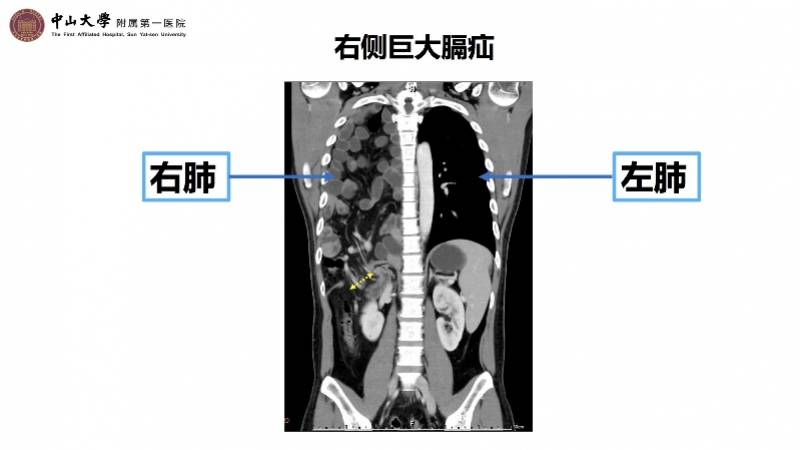 手术|过量运动后肠道“搬家”，巨大膈疝致小肠、阑尾挤瘪右肺