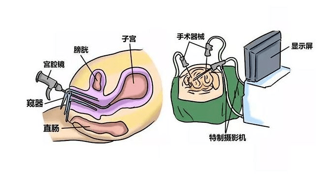 若患有子宮內膜息肉直接長在宮頸管內,可能會阻礙精子進入宮腔,直接