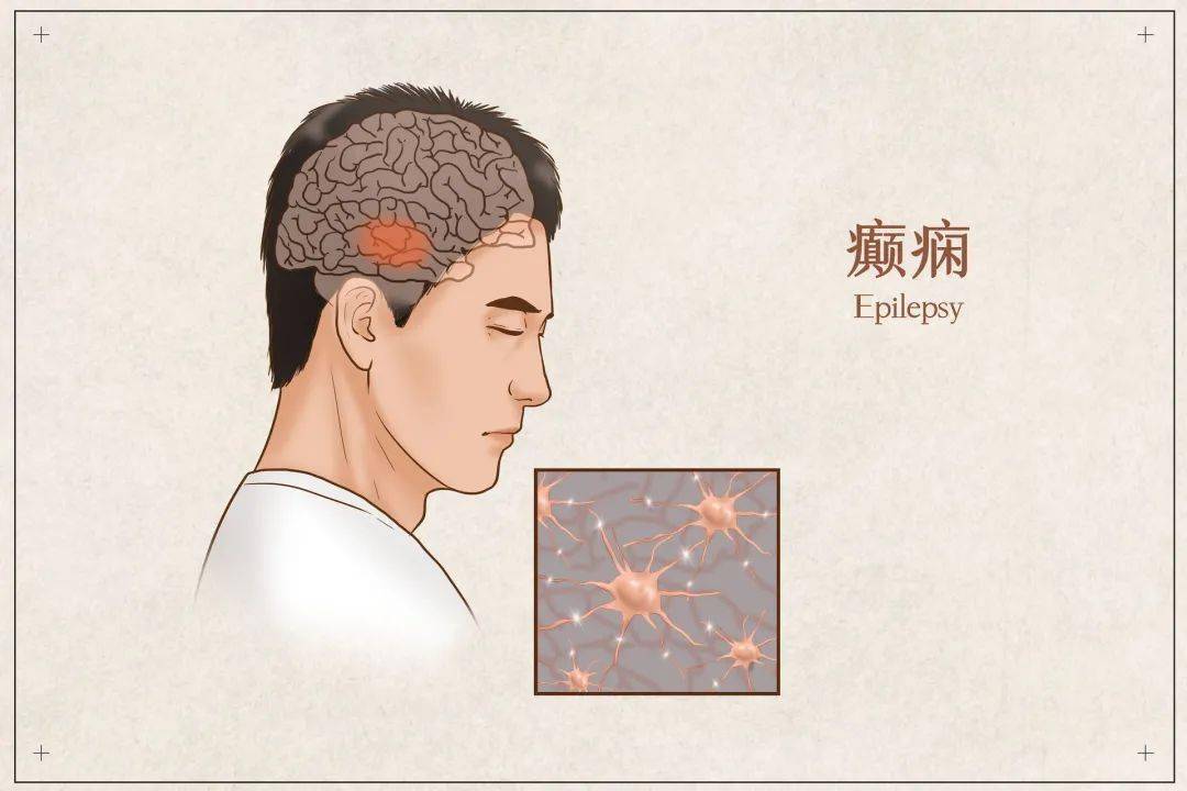 癫痫发作进医院熬夜实力背锅