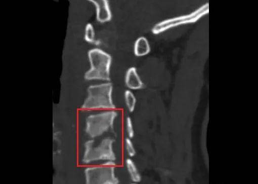 风险|两节颈椎被“吃掉”，五旬阿姨险瘫痪！
