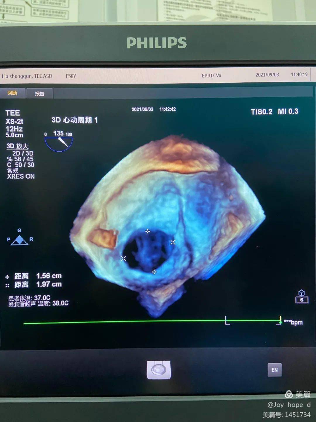 心脏超声的鹰眼经食道超声心动图