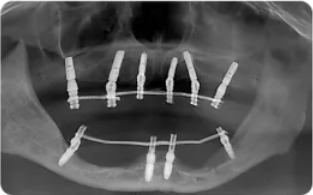 福利|种植牙大咖面对面+超强福利，机不可失，11—12日能省一大笔钱！！！