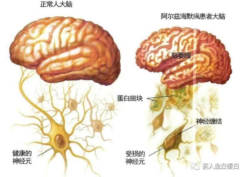 阿尔茨海默病,俗称老年痴呆症.