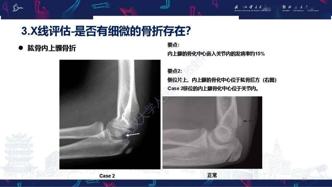 兒童肘關節外傷x線診斷_解剖圖