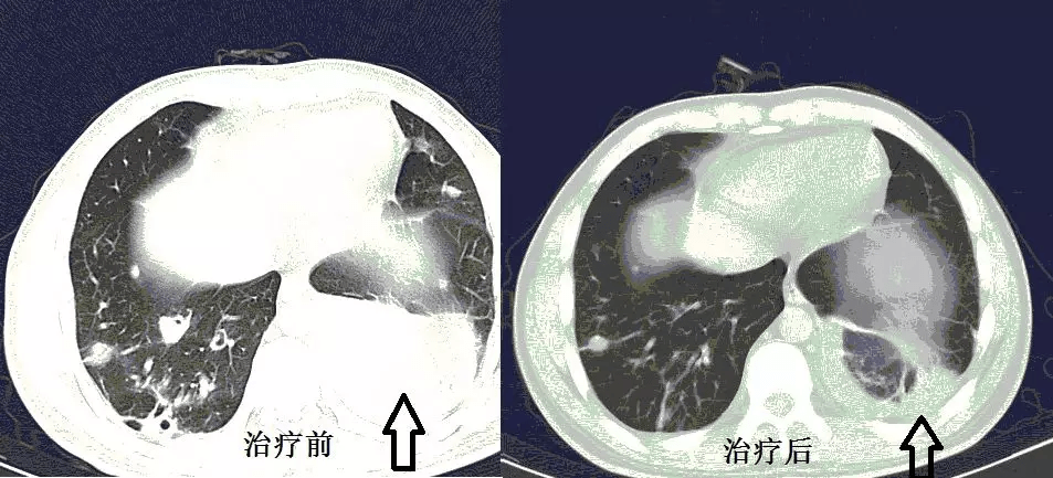 教你從肺ct上分辨是哪種細菌感染丨肺炎克雷伯桿菌篇