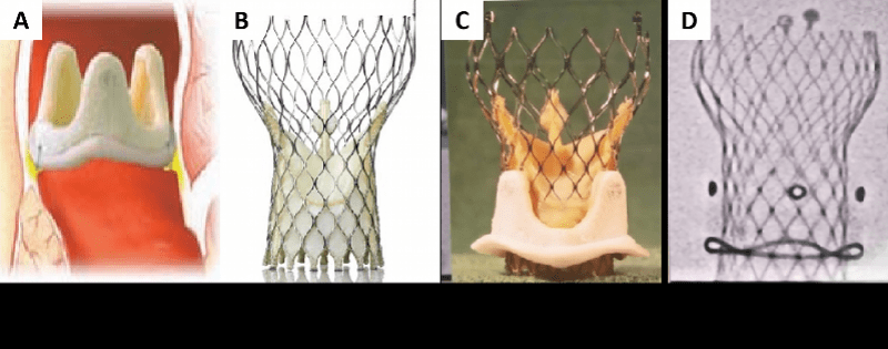 钟伯|七旬阿伯瓣膜病变只能“坐着睡”，新技术解决高龄换瓣难题