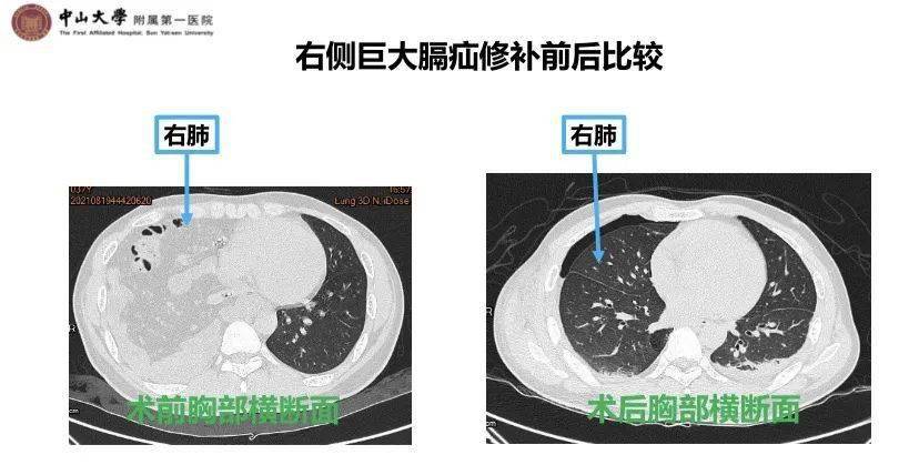 结肠|为减肚腩去健身，男子用力过猛结果悲剧了……