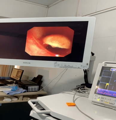 神秘的儿童纤维支气管镜