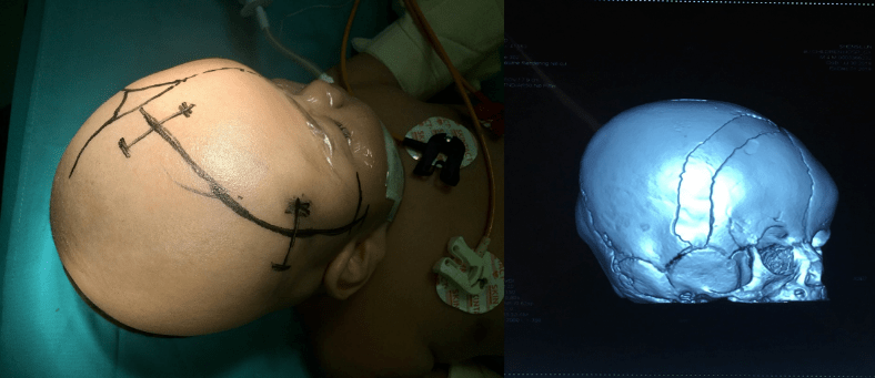 北京儿童医院张迪:婴幼儿颅缝早闭的治疗策略与心得