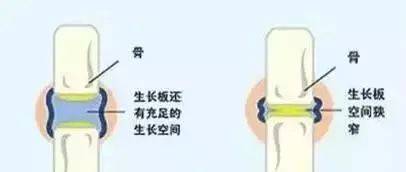 影响|为让女儿长高，每天逼其跳绳3000个，孩子走路直说疼