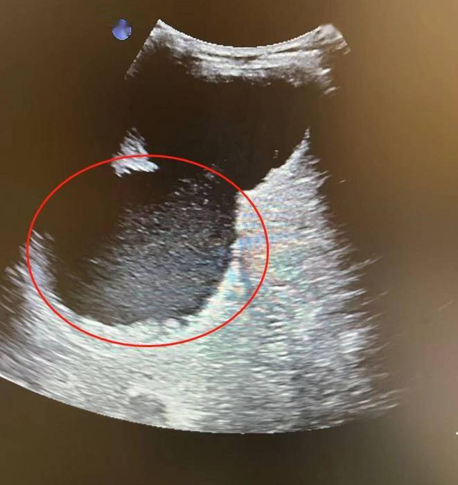 肝上长18厘米巨大囊肿置管引流5天才排净
