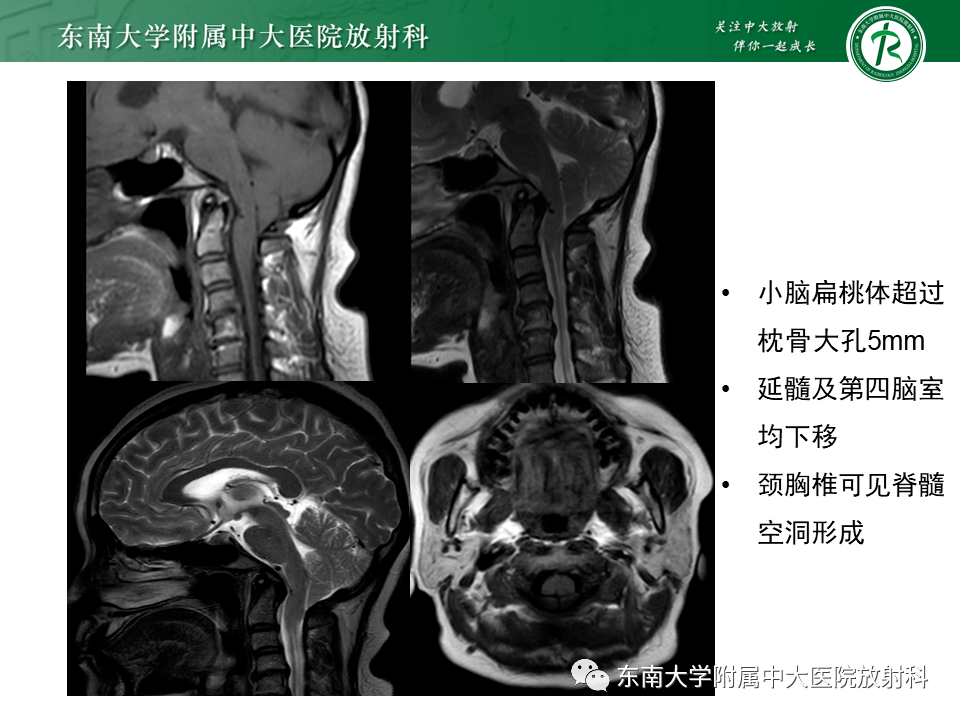 【晨讀結果公佈】2021.09.17 神經系統疾病——小腦扁桃體下疝畸形_放