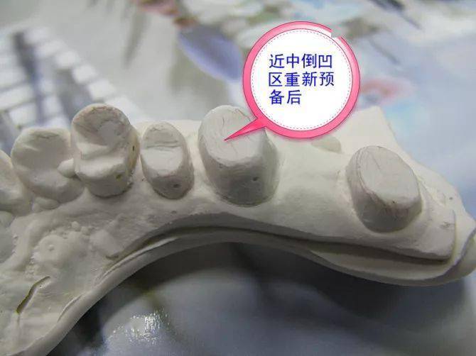 基牙倒凹 与 备牙时“就位道”的处理_预备
