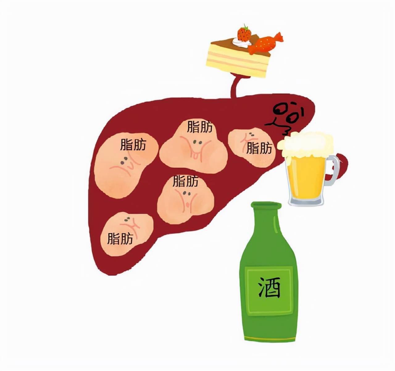 记好5大饮食原则,怎么吃出的脂肪肝,就怎么吃回去